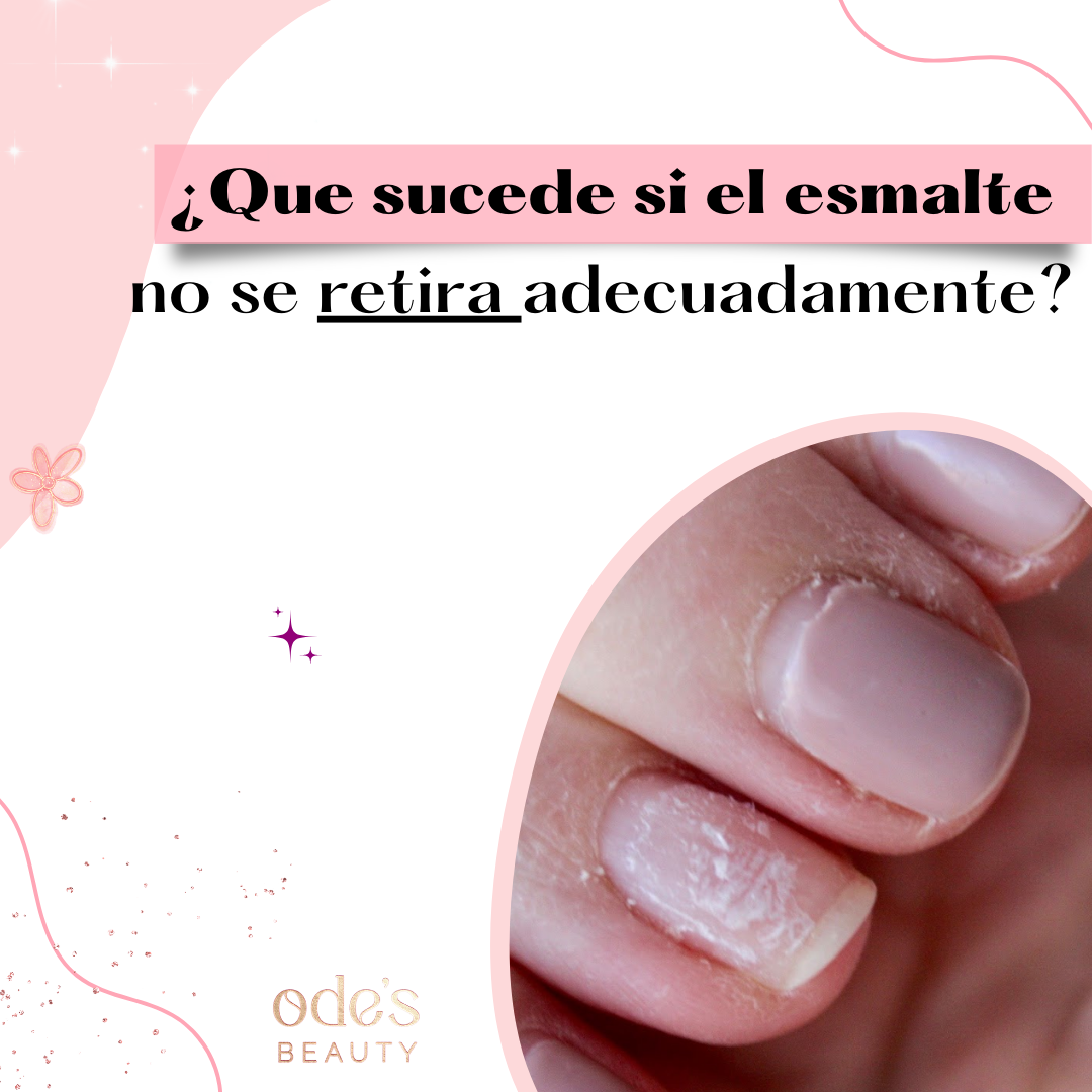 ¿Qué sucede si el esmalte no se retira adecuadamente?